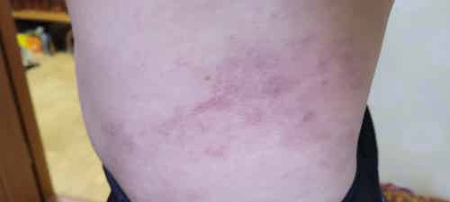 varicoza bruise photo)